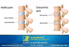 Rheumatoid Arthritis, Peneyebab Nyeri pada Punggung, Leher, Lengan dan Kaki