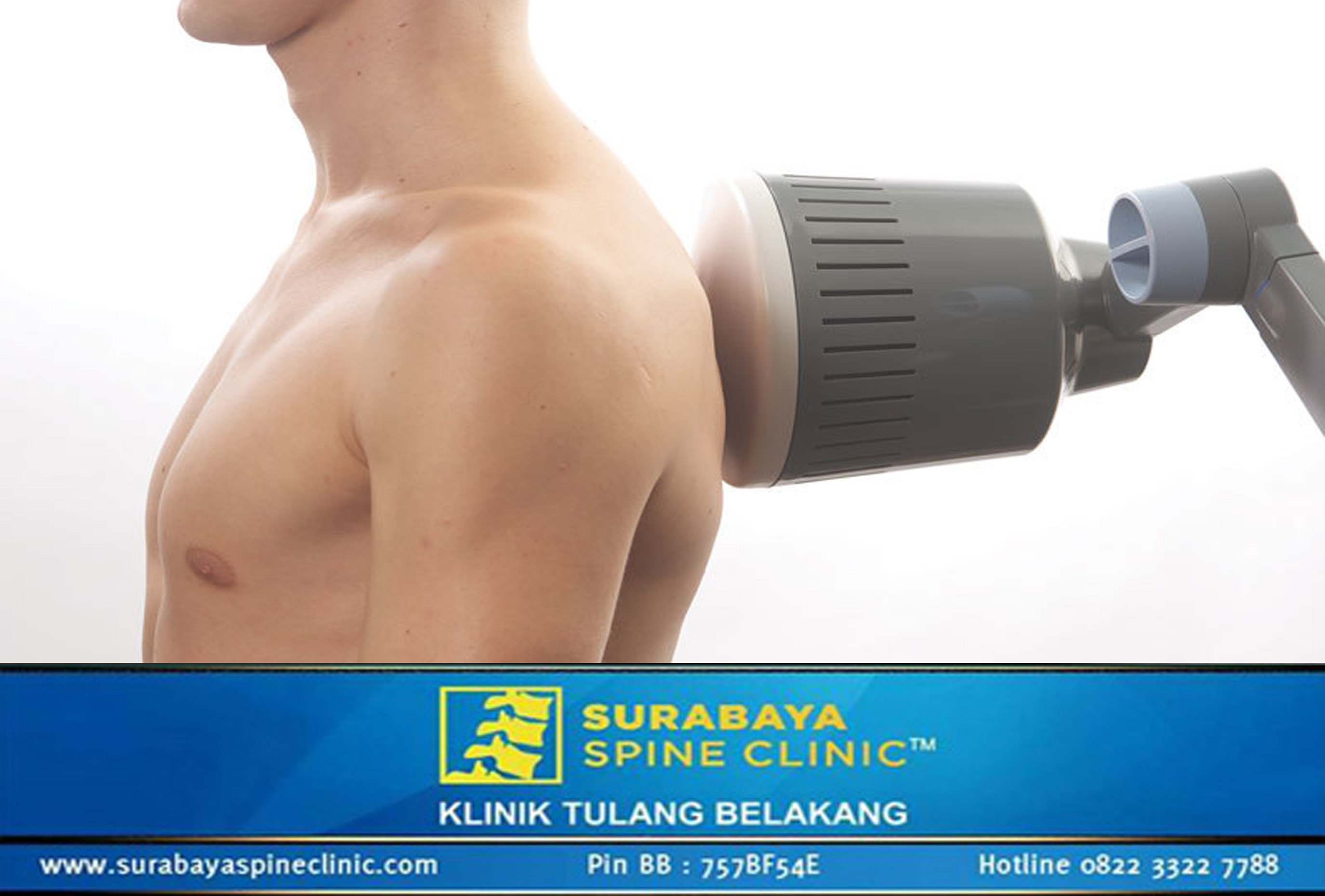 SWD, Membangkitkaan Panas Untuk Mengurnagi Rasa Nyeri Punggung