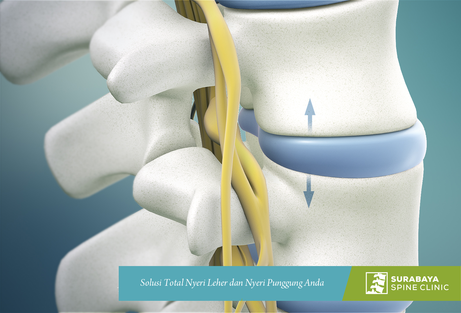 Standarad Emas Bedah Tulang Belakang : Microdiscectomy (Microdecompression) 