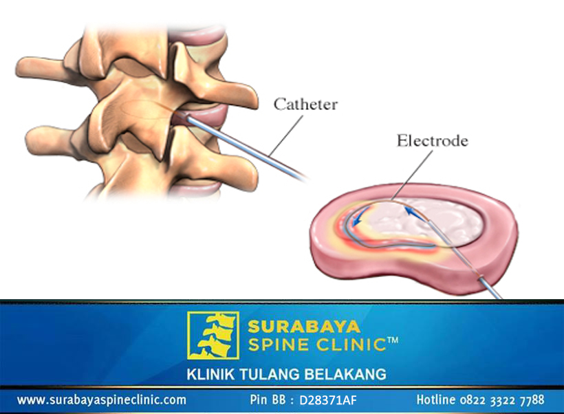IDET, Intradiscal Electrothermal Therapy. Terapi untuk Saraf Terjepit 