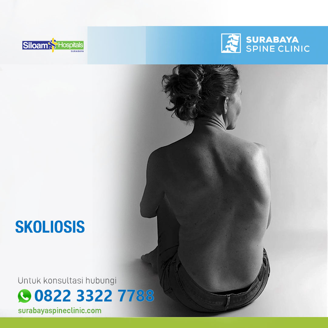 Ancaman Tak Terlihat: Bagaimana Melindungi Diri Anda dari Skoliosis